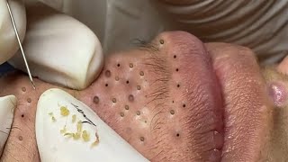 Big Cystic Acne Blackheads Extraction Blackheads amp Milia Whiteheads Removal Pimple Popping  3846 [upl. by Chloe]