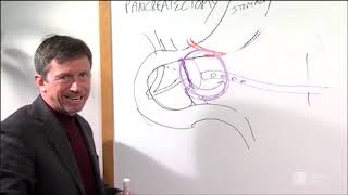 Distal Pancreatectomy Procedure  Roswell Park Patient Education [upl. by Eibrad]