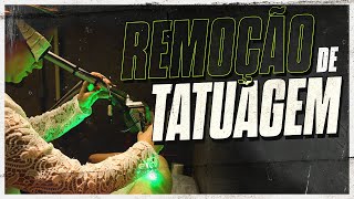 Processo de remocÌ§aÌƒo de tatuagem Antes e depois [upl. by Leidba]