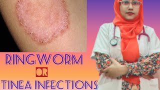 RingwormSings amp Symptoms of Tinea Infectionsringworm tinea tineainfectionsdermatophytosis [upl. by Eelrehpotsirhc]