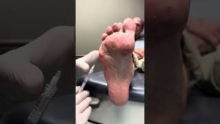 Radiesse dermal filler injections for pain on the ball of the foot [upl. by Granville]