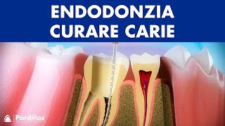 Endodonzia – Curare carie profonda © [upl. by Acina978]