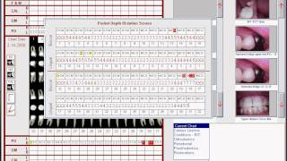 Perio Charting Part 2 [upl. by Siaht637]