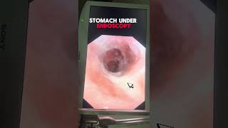 Understanding Stomach Ulcers An InDepth Look Under Endoscopy [upl. by Beatty]