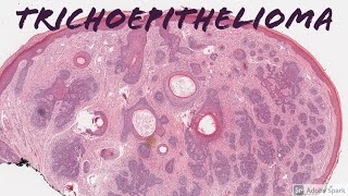 Trichoepithelioma 101 [upl. by Rhynd]