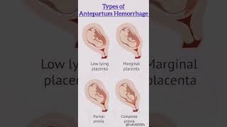 Types of Antepartum Hemorrhage  antepartumhemorrhage viralvideo [upl. by Aneleh]