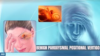 Benign Paroxysmal Positional Vertigo What You Need To Know [upl. by Buine]