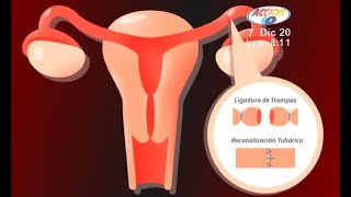 Salpingoclasia Ligadura de Trompas ¿Puedo quedar embarazada y volver a tener un bebé  Ingenes [upl. by Cissy]