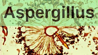 Aspergillus and Aspergillosis  Pathology mini tutorial [upl. by Vinaya]