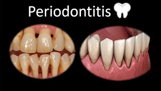 🦷 Periodontitis  Cavidad oral  Cabeza y Cuello  Patología [upl. by Orola]