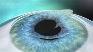 LASIK Eye Surgery Animation [upl. by Irtimid]