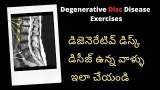 Disc Degeneration Disease DDD Treatment for Degenerative Disc Disease Lumbar Disc L4L5 L5S1 [upl. by Trey]