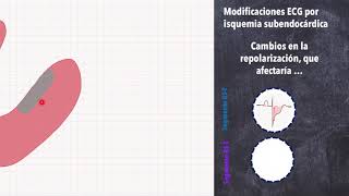 Cardiopatía isquémica 56 SICA SIN ELEVACION DEL ST [upl. by Shannah]