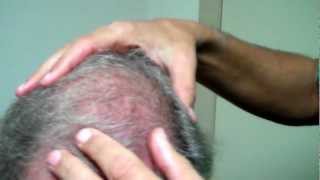 Dr Jeffrey Epstein 11 Months PostOp Chest to Scalp FUE [upl. by Tillman609]