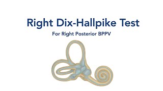 At Home Right DixHallpike Test for BPPV Vertigo [upl. by Anade503]