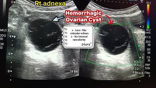 Hemorrhagic Ovarian Cyst [upl. by Thomasine]