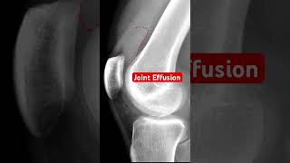 Joint Effusion of the Knee kneepain bones medical [upl. by Ecenaj33]