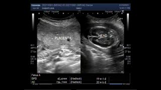 Fetal anomalies Dilated ventricles Missing limbs Oligohydramnios and Missing fetal movements [upl. by Ynnohj]