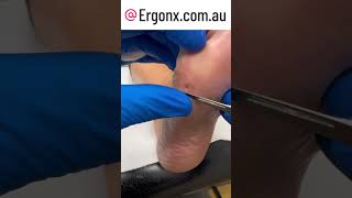 Large corn removal from foot by podiatrist in australia very satisfying tonwatch and for the pati [upl. by Shalna]