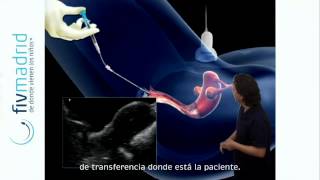 Transferencia embrionaria en FIV [upl. by Annahs]