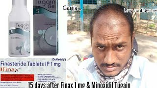 Finasteride Finax 1mg amp Minoxidil gel 5 review after 15 days or use stophairfallsoon [upl. by Hillier]