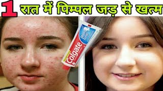 Colgate 1 रात में pimple ऐसे खत्म करेगा की दोबारा कभी नही आएँगे । Remove pimples with Colgate [upl. by Alesandrini]