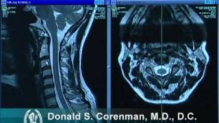 How to Read a MRI of the Normal Cervical Spine Neck  Colorado Spine Expert [upl. by Nivrae]