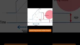 Time Standardised Management of ARDS [upl. by Deuno]