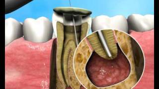 Treatment of Apical Periodontitis  a new approach [upl. by Meit]