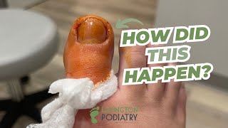 Partial TOENAIL Removal [upl. by Matusow]