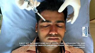 Regional Nerve Block for Scalp  Local Anaesthesia for PRP amp other scalp procedures [upl. by Gyatt898]