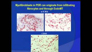 Corneal Neovascularization [upl. by Saw]