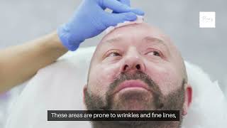 Brotox Explained Get Rid of Wrinkles Fast in prospertx littleelmtx [upl. by Doone414]