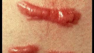 DermTV  How to Treat a Keloid Scar DermTVcom Epi 279 [upl. by Bord]