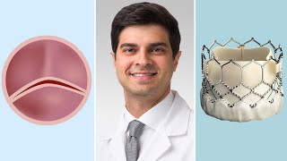 Bicuspid Aortic Valves Surgical amp Transcatheter Aortic Valve Replacement Options for Patients [upl. by Gnurt106]