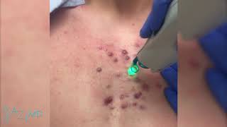 Keloid Scar Treatment [upl. by Winchester842]