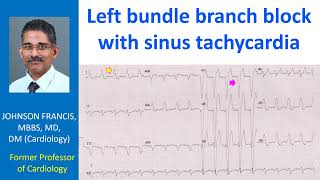 Left bundle branch block with sinus tachycardia [upl. by Allebasi]