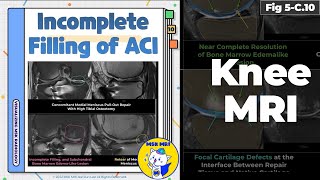 Fig 5C10 Incomplete Filling of Autologous Chondrocyte Implantation [upl. by Nivonod]