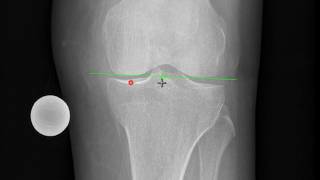 mediCAD  Long Leg  Osteotomy [upl. by Vallery]