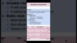 Ventricular Tachycardia [upl. by Ornstead]