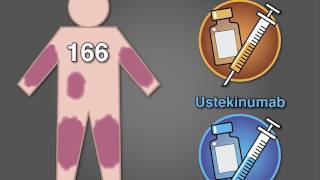 Risankizumab vs Ustekinumab for Psoriasis [upl. by Dine797]