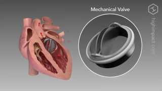 Heart Valve Replacement Options [upl. by Egas]