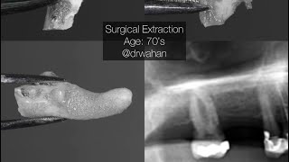 Surgical Maxillary Molar Extraction with Sectioning and Tongue Retraction Tip [upl. by Nelo57]