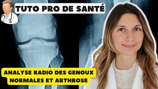 Comment interpréter radiographie genou [upl. by Kavita308]