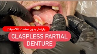 MAKING PARTIAL DENTURE WITHOUT CLASPS FLIPPER ALL STEPS FROM CAST TO INSERTION waxbae flipper [upl. by Acherman524]