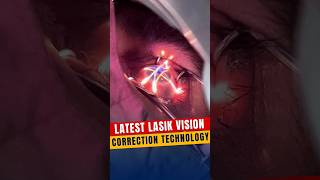 Latest Lasik Vision Correction Technology [upl. by Atiuqnahs]