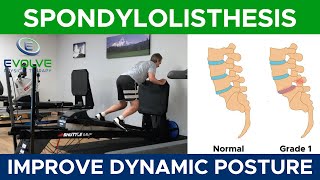 Spondylolisthesis  Exercises To Improve Dynamic Lumbopelvic Stability  Part 5 [upl. by Amar]