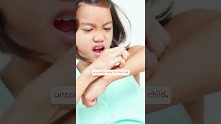 Seborrheic Dermatitis in Children Advices and Solutions babyhealth seborrheicdermatitis [upl. by Ahtanamas]