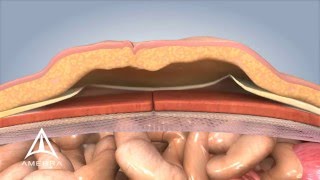 Ventral Hernia Repair  3D Medical Animation [upl. by Libb]