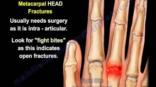 Metacarpal Fractures  Everything You Need To Know  Dr Nabil Ebraheim [upl. by Race]